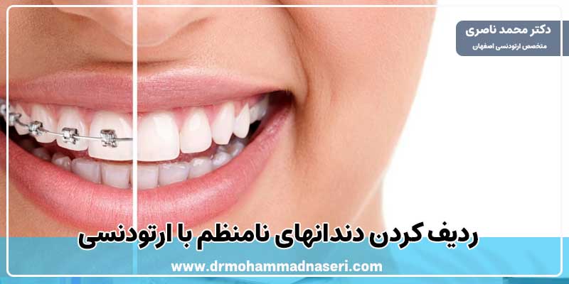 ردیف کردن دندانهای نامنظم با متخصص ارتودنسی در اصفهان