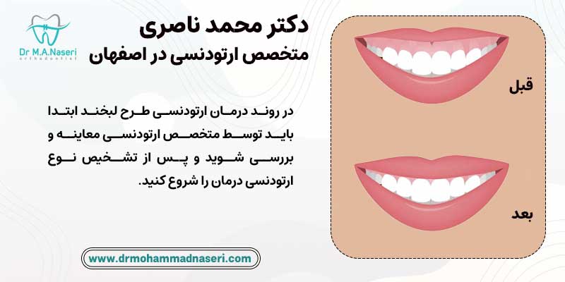 قبل و بعد از ارتودنسی اصلاح لبخند | دکتر محمد ناصری متخصص ارتودنسی در اصفهان