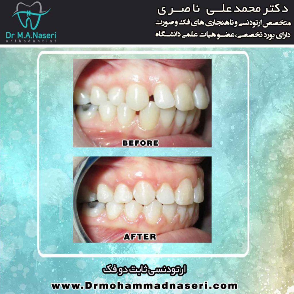 تاثیرات ارتودنسی بر صورت افراد