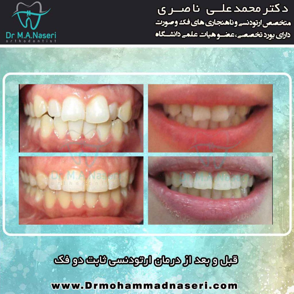 تاثیرات ارتودنسی بر صورت افراد