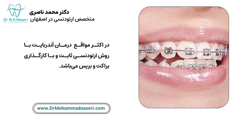 نحوه درمان آندربایت | دکتر محمد ناصری متخصص ارتودنسی اصفهان