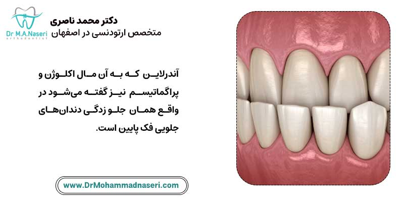 آندربایت چیست | دکتر محمد ناصری متخصص ارتودنسی اصفهان