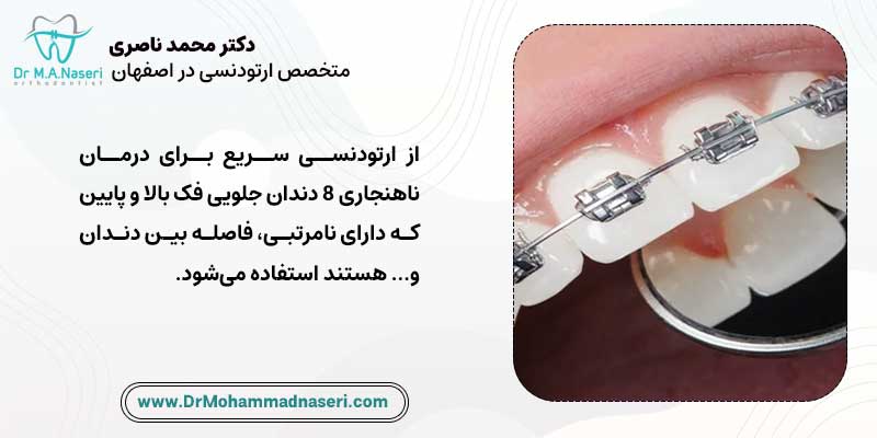 ارتودنسی کوتاه مدت برای چه کسانی مناسب است | دکتر محمد ناصری متخصص ارتودنسی در اصفهان