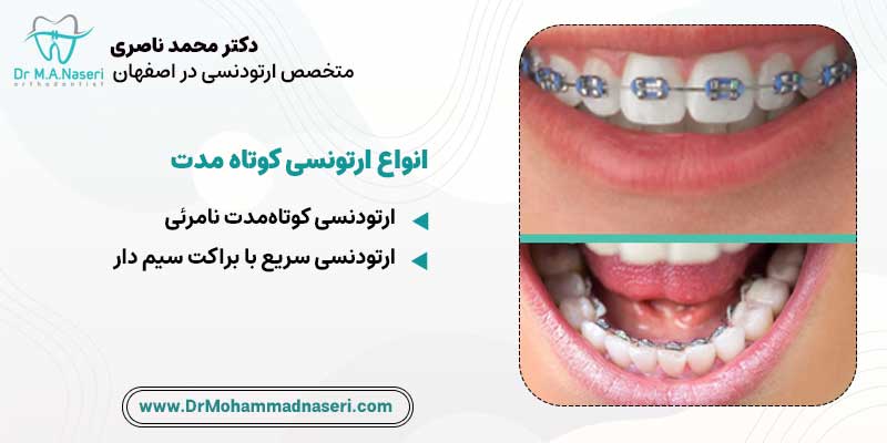 انواع ارتودنسی کوتاه مدت | دکتر محمد ناصری متخصص ارتودنسی در اصفهان