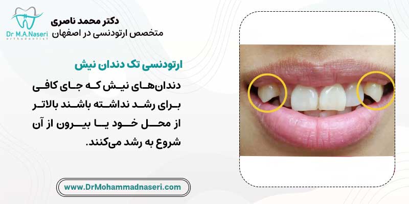 ارتودنسی تک دندان نیش | دکتر محمد ناصری متخصص ارتودنسی در اصفهان