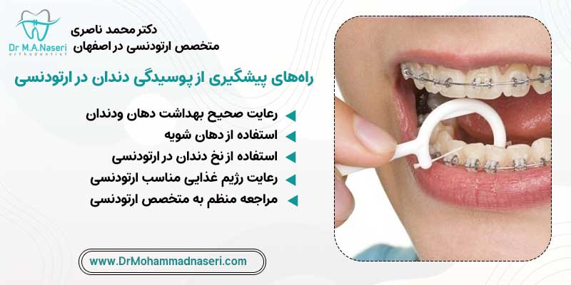 راه‌های پیشگیری از پوسیدگی دندان در ارتودنسی