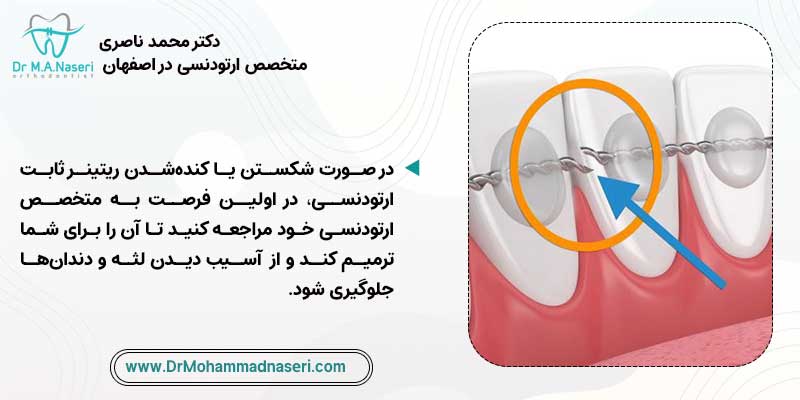 شکستن ریتینر ثابت ارتودنسی