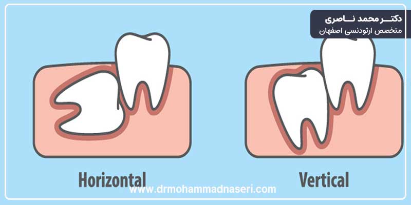 کج در امدن دندان عقل