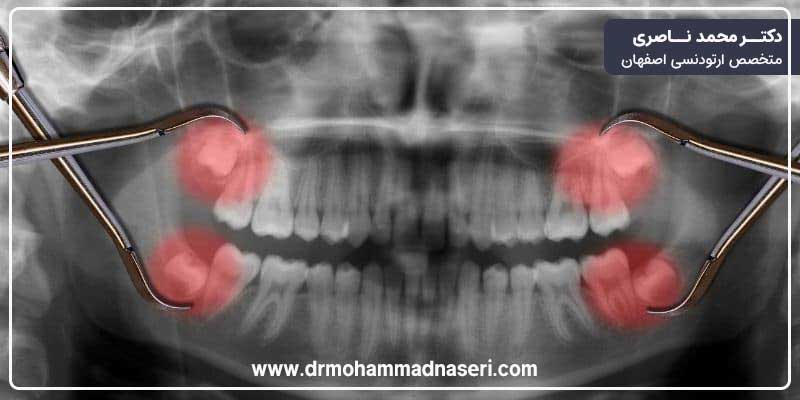 رویش دندانهای عقل