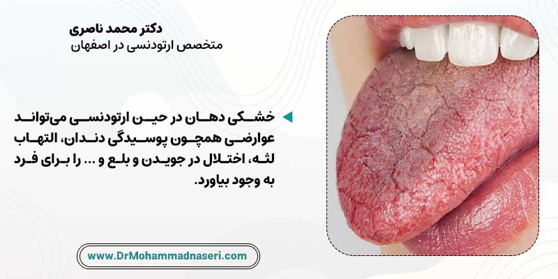 عوارض خشکی دهان در حین ارتودنسی