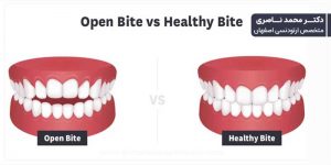 قبل و بعد از درمان ناهنجاری اپن بایت
