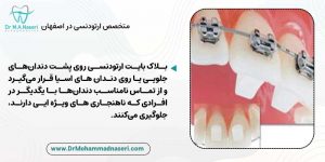 بلاک بایت ارتودنسی چیست؟