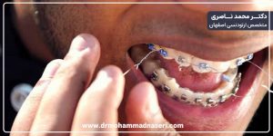مشکل پاره شدن سیم در حین درمان ارتودنسی