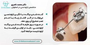 عارضه کنده شدن براکت ارتدنسی حین درمان