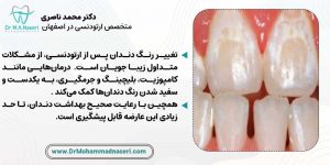 مشکل تغییر رنگ دندان بعد از ارتونسی