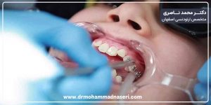 باندینگ ارتودنسی