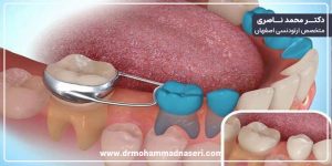 فضا نگهدار دندان