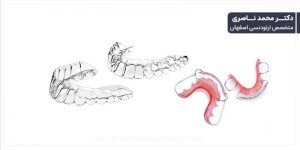 انواع ارتودنسی متحرک