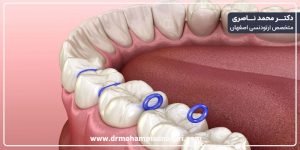 سپراتور ارتودنسی