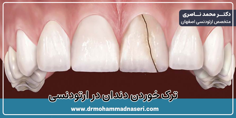 ترک خوردن دندان در ارتودنسی