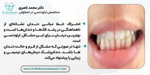 درمان ناهماهنگی خط میدلاین دندان