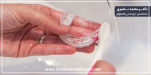 تمیز کردن ارتودنسی متحرک