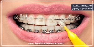 تمیز کردن ارتودنسی ثابت با مسواک مخصوص ارتودنسی