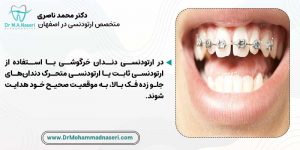 ارتودنسی دندان خرگوشی