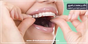 نحوه صحیح قرار دادن پلاک متحرک ارتودنسی