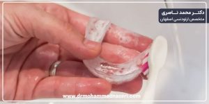 شستن پلاک متحرک ارتودنسی