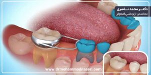 فضانگهدار دندان شیری