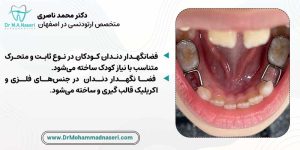 انواع فضانگهدار دندان