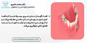 کاربرد فضانگهدار دندان