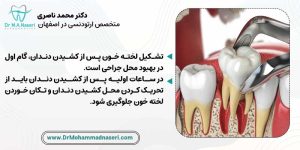 مراقبت های ضروری در ساعات اولیه بعد از کشیدن دندان