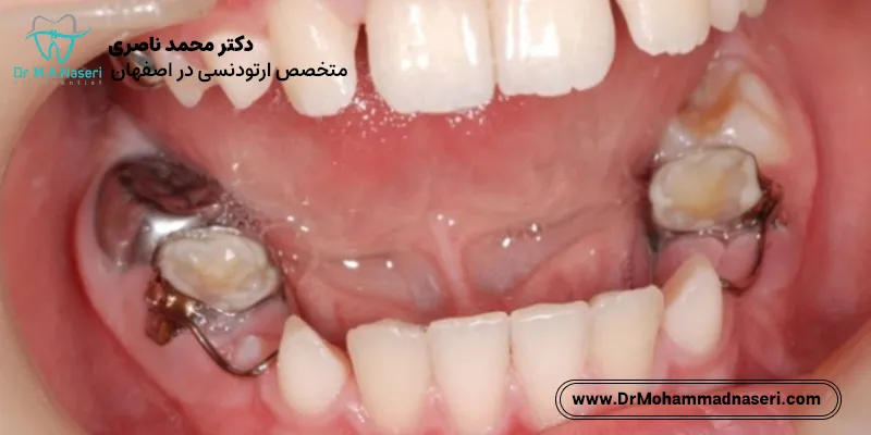 فضانگهدارنده دندان کودک