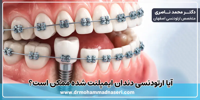 ارتودنسی دندان ایمپلنت شده